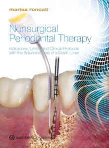 Non-Surgical Periodontal Therapy With the Adjunctive Use of a Diode Laser