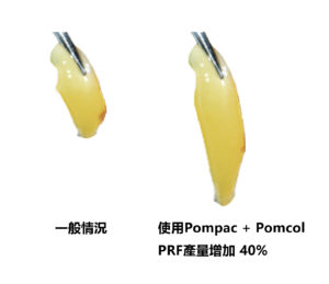 Duo Quattro PRF 離心機 -Pompac Pomcol PRF 產量增加40%